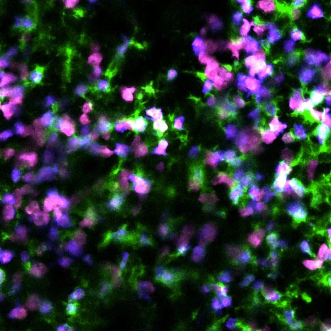 Lösemide üçlü tedavi başarısı: Bağışıklık sistemi yeniden programlandı