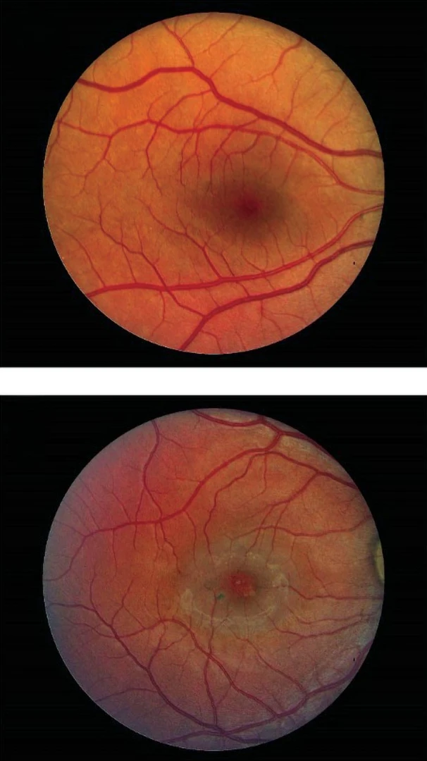 ‘Encelto’  ile retina hastalığında önemli gelişme