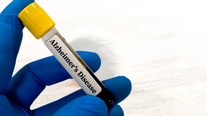 Alzheimer belirtileri yeni kan testiyle yıllar öncesinden tahmin edilecek