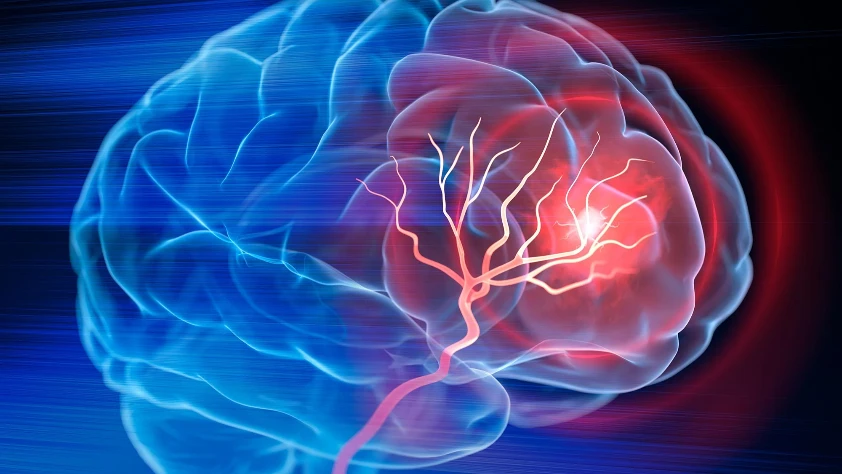 İnme tedavisinde devrim: Beyin hasarını onaran nanoteknoloji