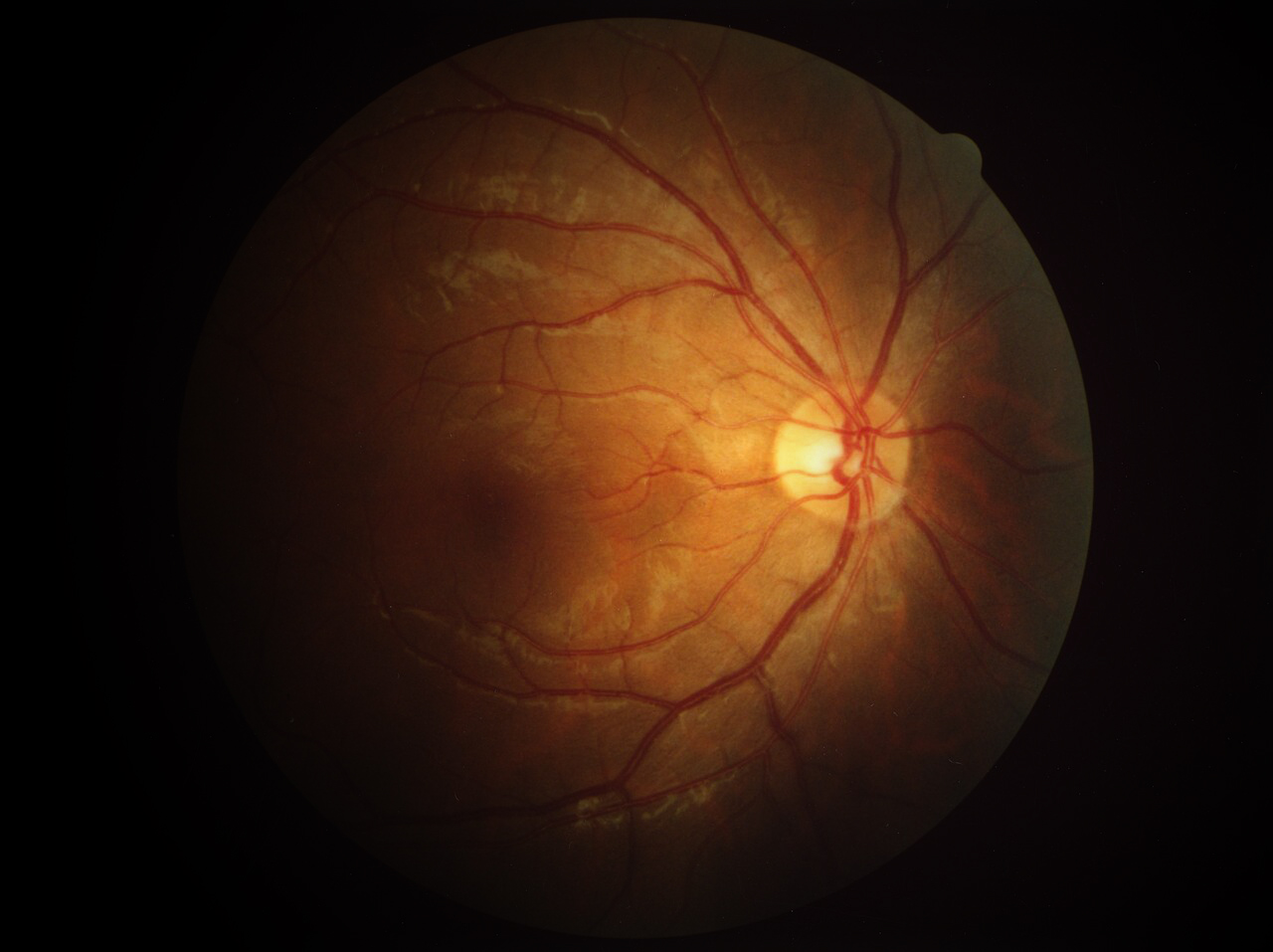Yapay zeka retina taramasıyla kronik hastalık risklerini anında belirliyor